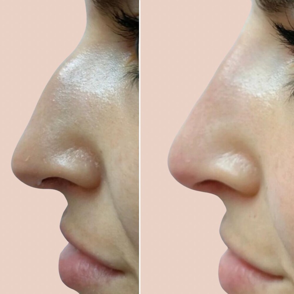 Before and After Result